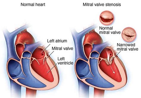 severe mitral stenosis